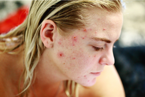 girl with acne