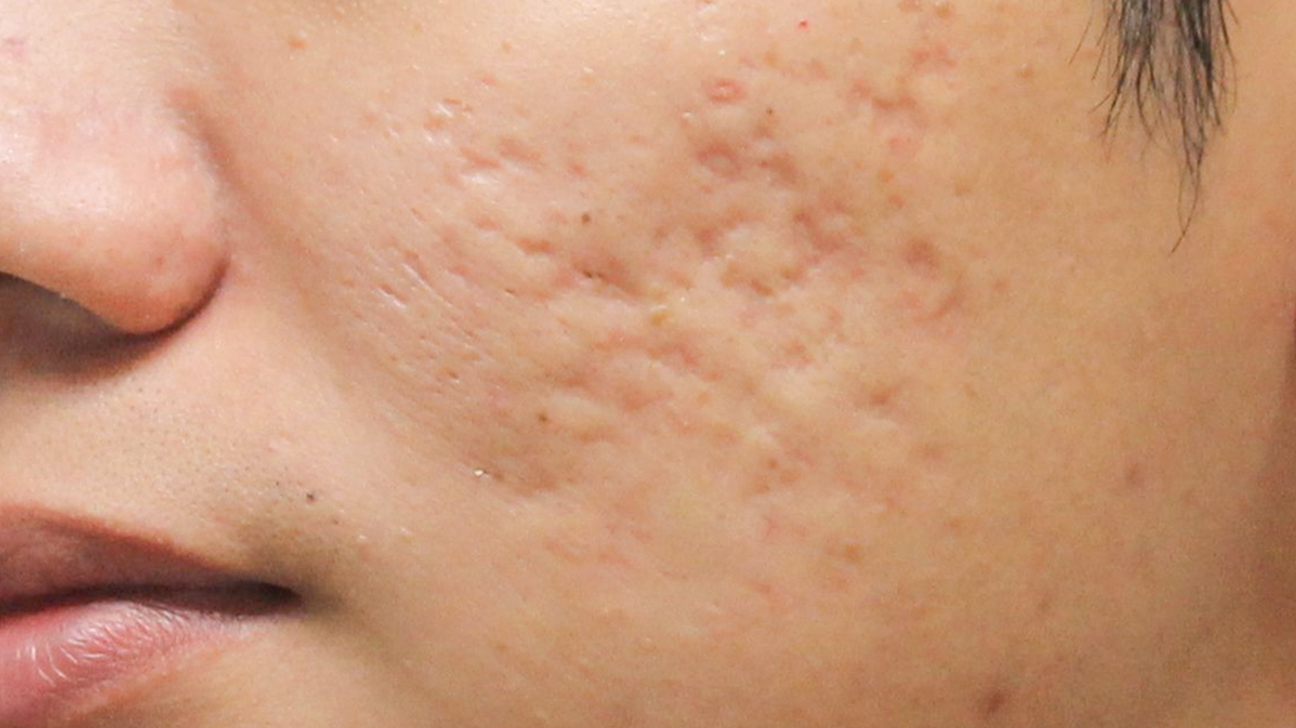 15 Treatments That Help Fade Even the Most Stubborn Acne Scars