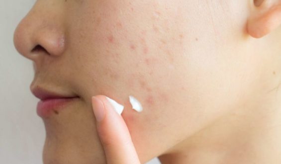 15 Treatments That Help Fade Even the Most Stubborn Acne Scars