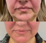 What You Need to Know About Morpheus8 Treatments