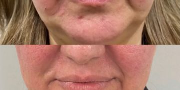 Morpheus8 Treatments