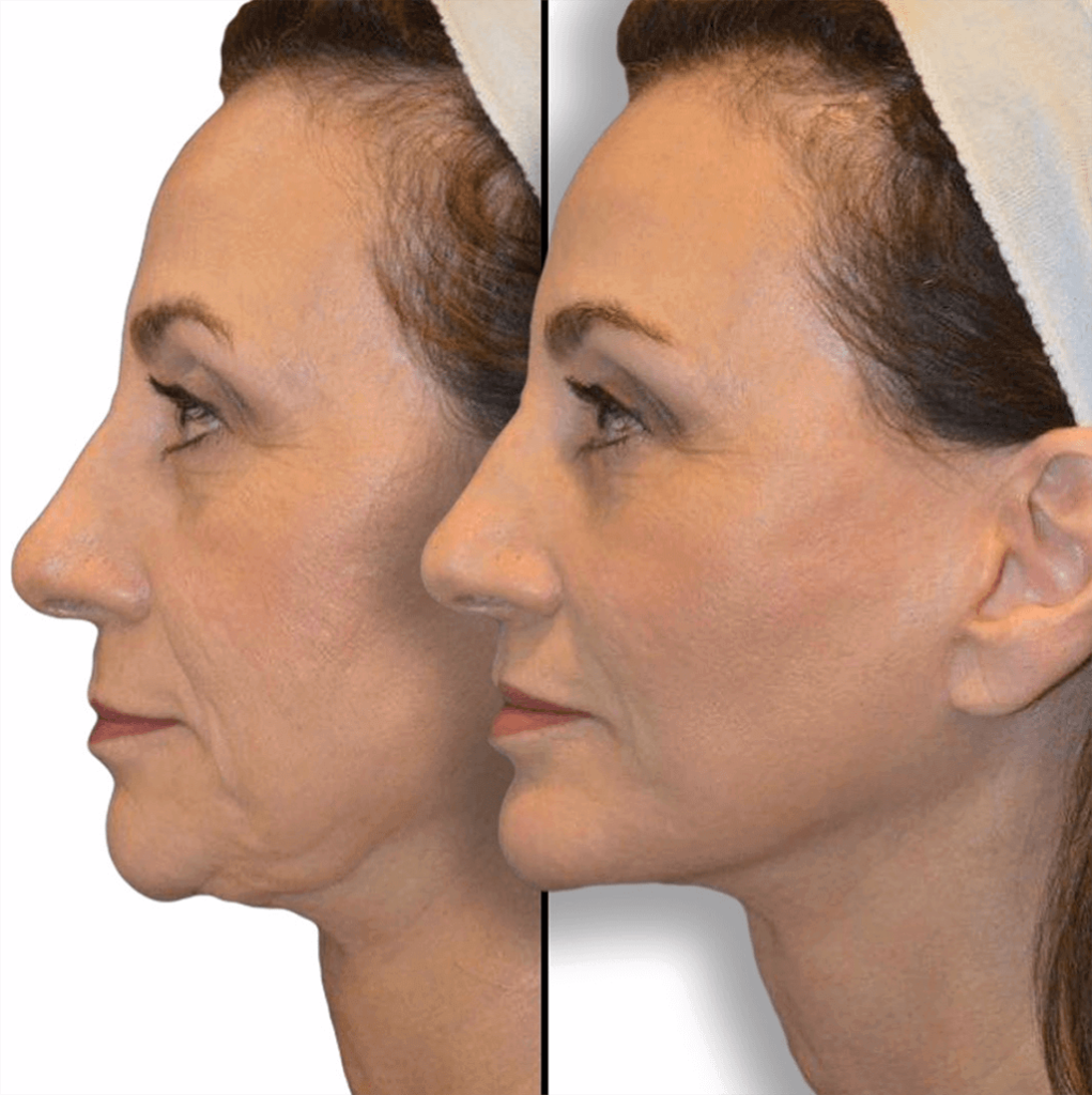 Are You a Man Looking for a Neck Lift?