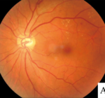 A Complete Guide to Diabetic Macular Edema