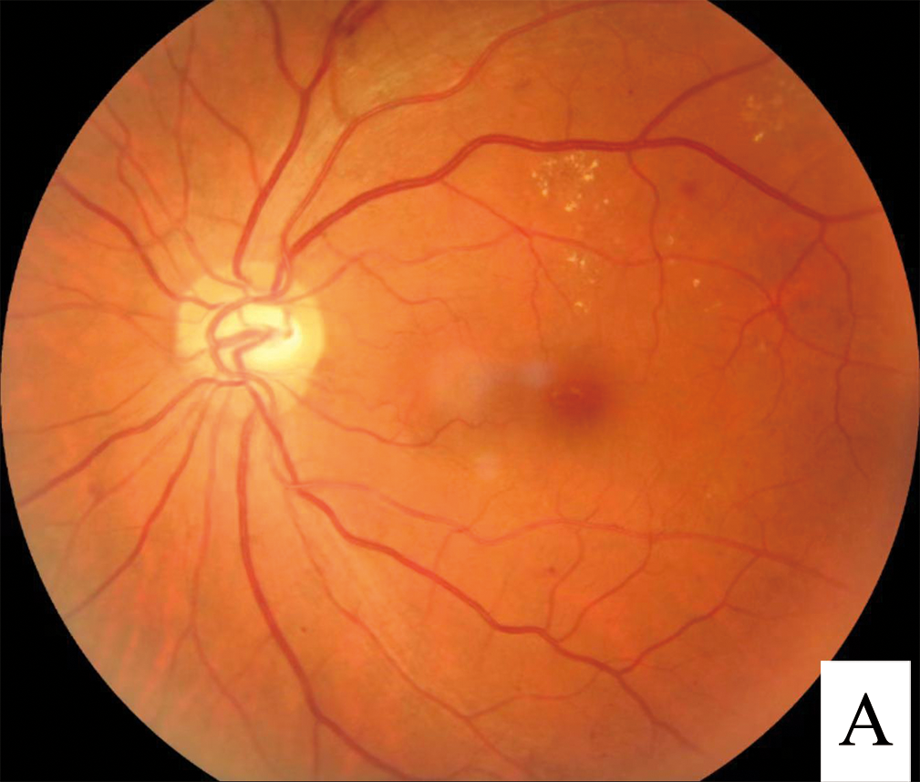 A Complete Guide to Diabetic Macular Edema