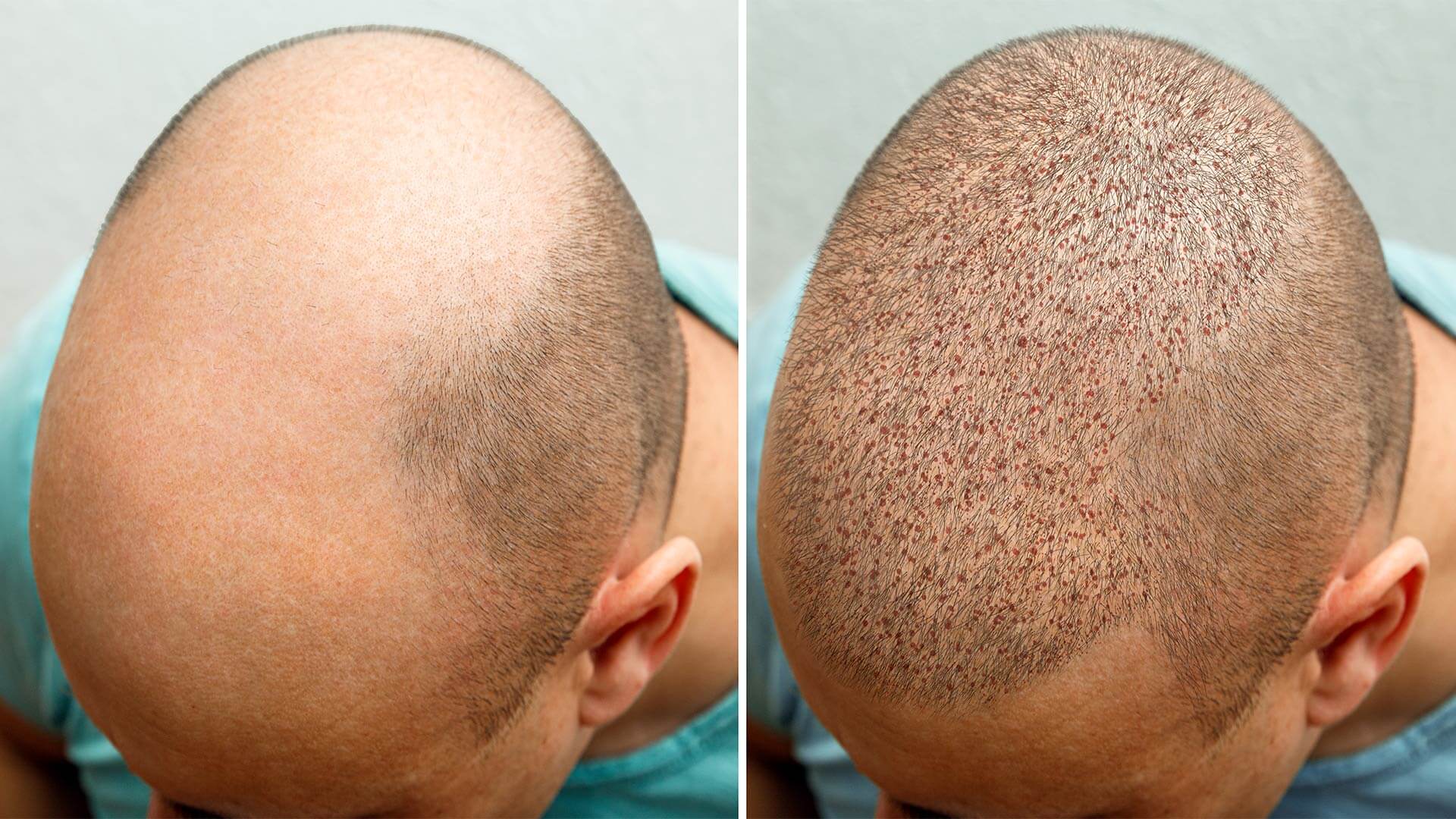Tips for Achieving Your Desired Hair Transplant Results