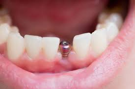 Explore the Benefits and Risks of Dental Implants