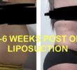 2 Weeks After Liposuction Photos: What to Expect Week by Week, Healing Milestones, and Realistic Results