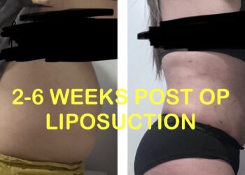 2 weeks after liposuction photos