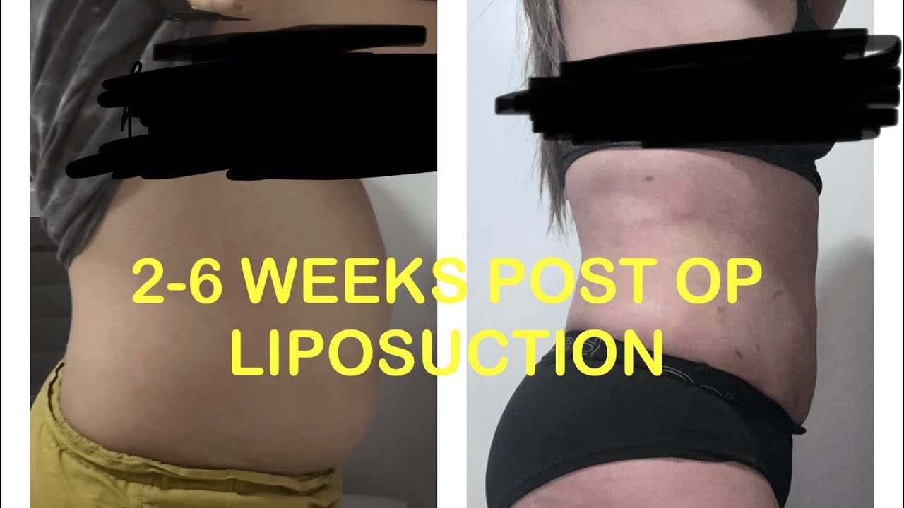2 Weeks After Liposuction Photos: What to Expect Week by Week, Healing Milestones, and Realistic Results