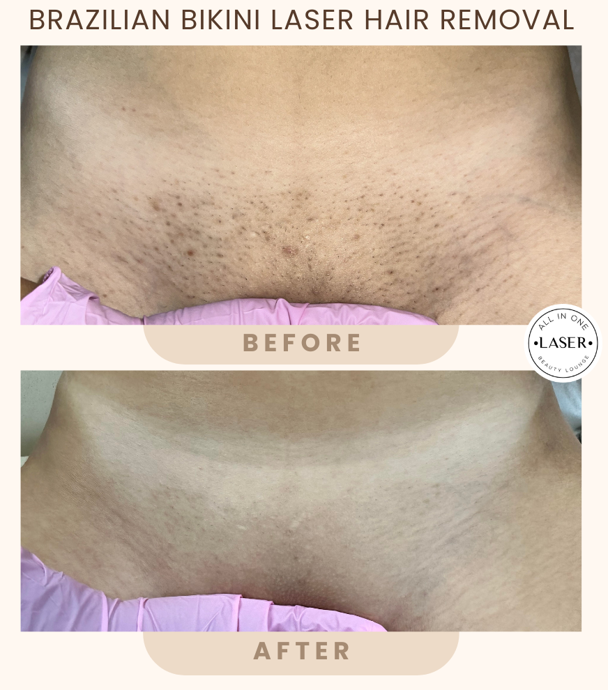 Full Brazilian Laser Hair Removal Before and After Photos