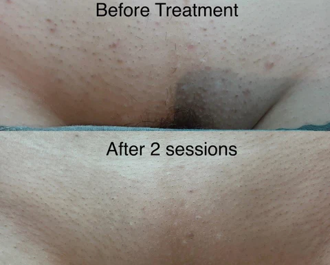 Full Brazilian Laser Hair Removal Before and After Photos