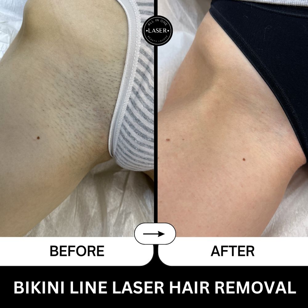 Full Brazilian Laser Hair Removal Before and After Photos