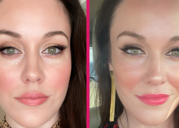 sebaceous hyperplasia before and after photos