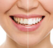 The Factors That Influence Long-Term Dental Restoration Results