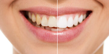 Dental Restoration