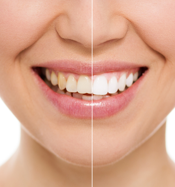 The Factors That Influence Long-Term Dental Restoration Results
